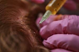 Injections of blood plasma in the face and head. High quality 4k footage