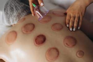 close up of cupping therapy
