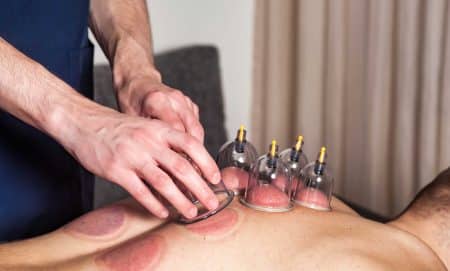 doctor doing cupping therapy for male patient