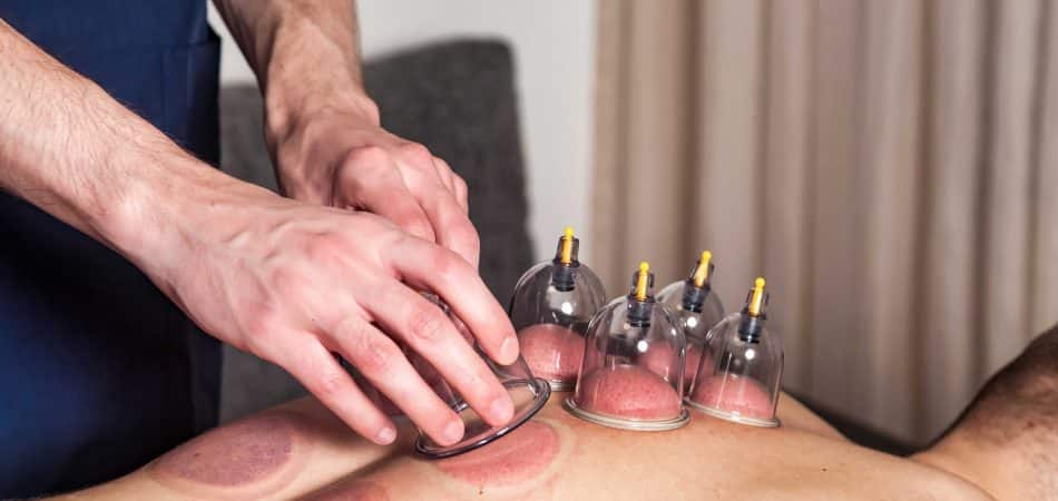 doctor doing cupping therapy for male patient