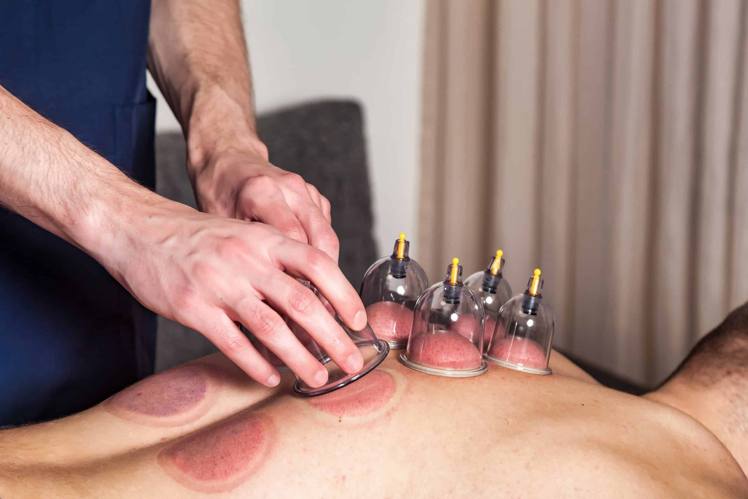 doctor doing cupping therapy for male patient